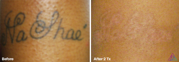 Before and after tattoo removal